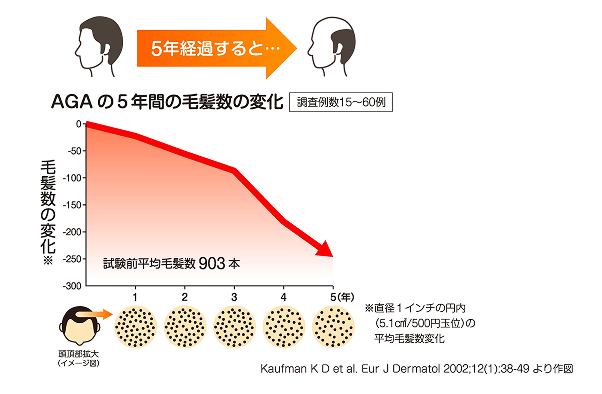 AGAの5年間の毛髪数の変化
