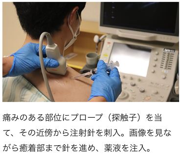 筋膜リリースの画像