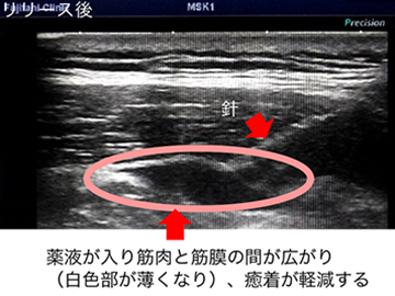 筋膜リリースの画像